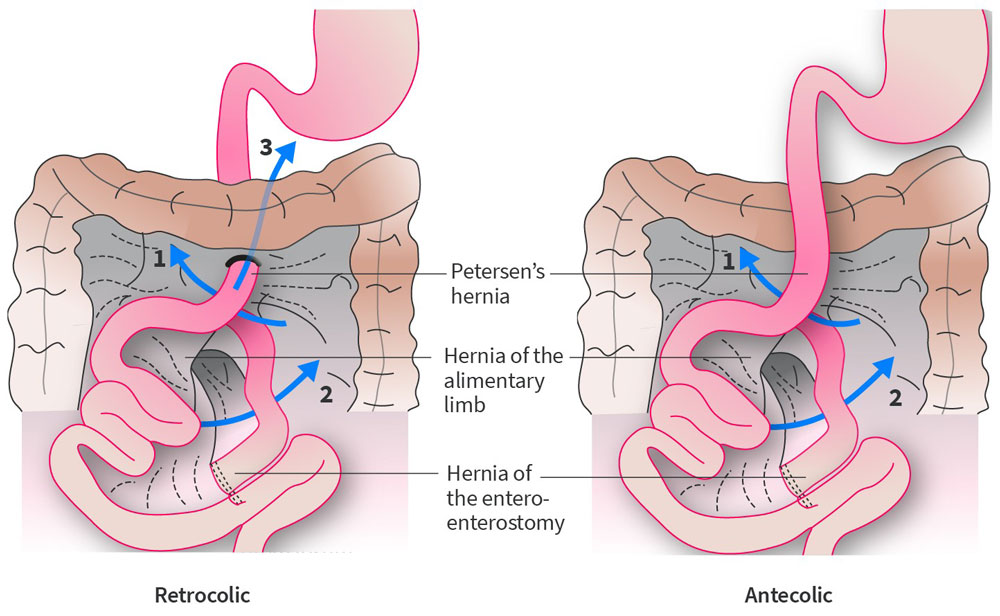 Explore the Benefits, Challenges, and Considerations of Single Port Bariatric Surgeries(图1)